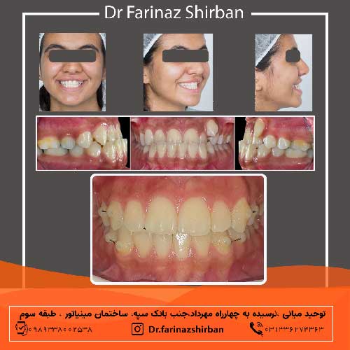 نمونه ارتودنسی انجام شده توسط دکتر فریناز شیربان متخصص ارتودنسی در اصفهان