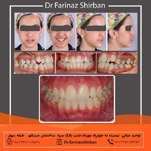 نمونه ارتودنسی انجام شده توسط دکتر فریناز شیربان متخصص ارتودنسی در اصفهان