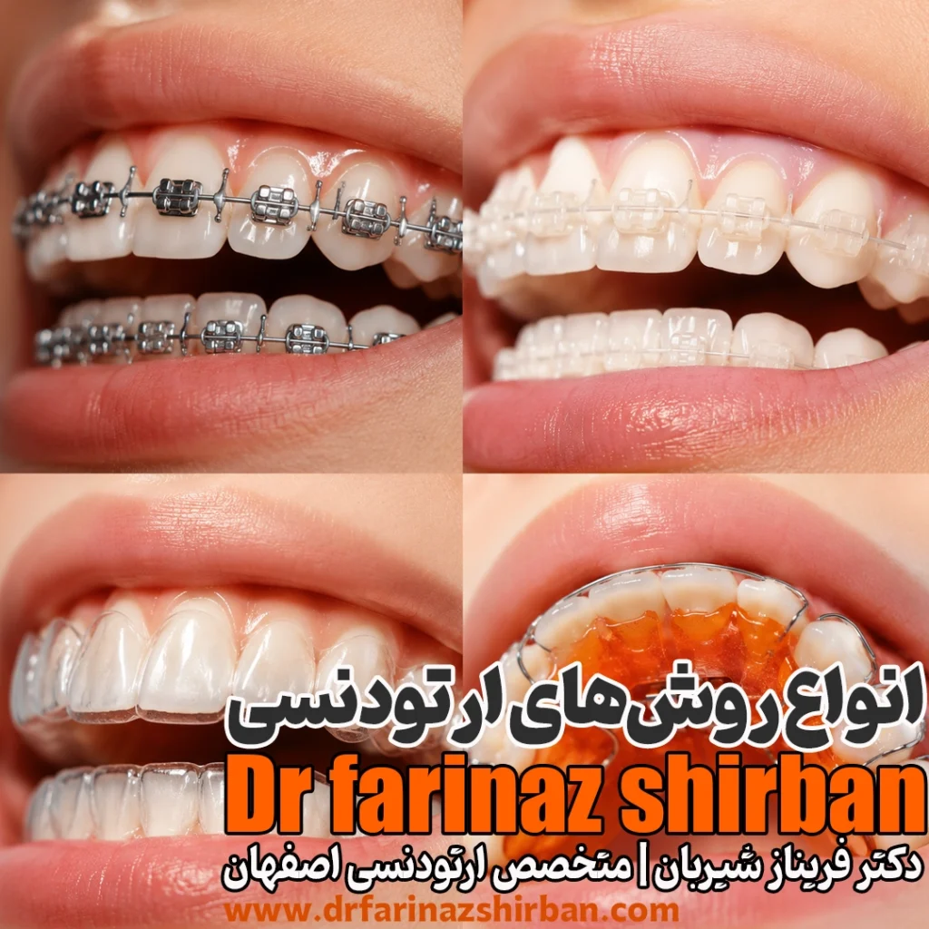 انواع روش‌های ارتودنسی راهنمای انتخاب بهترین روش ارتودنسی بهترین نوع ارتودنسی + عکس ها