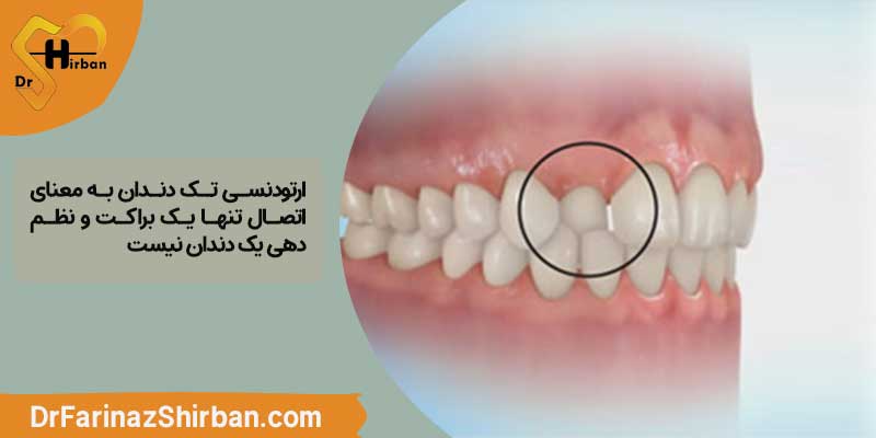 روش ارتودنسی تک دندان