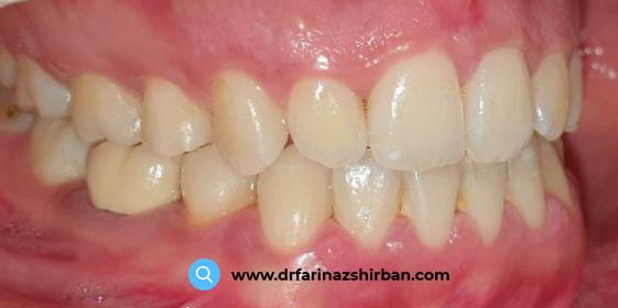 درمان به هم نرسیدن دندان های جلو توسط دکتر فریناز شیربان بهترین متخصص ارتودنسی در اصفهان