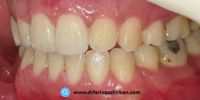 درمان به هم نرسیدن دندان های جلو توسط دکتر فریناز شیربان بهترین متخصص ارتودنسی در اصفهان