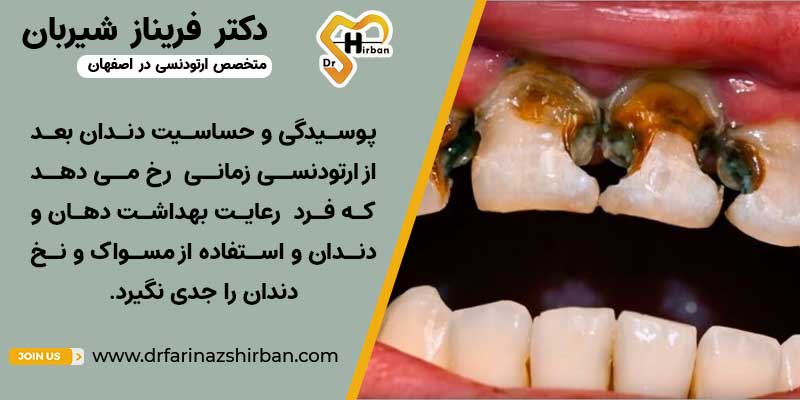 علت پوسیدگی و حساسیت دندان بعد از ارتودنسی