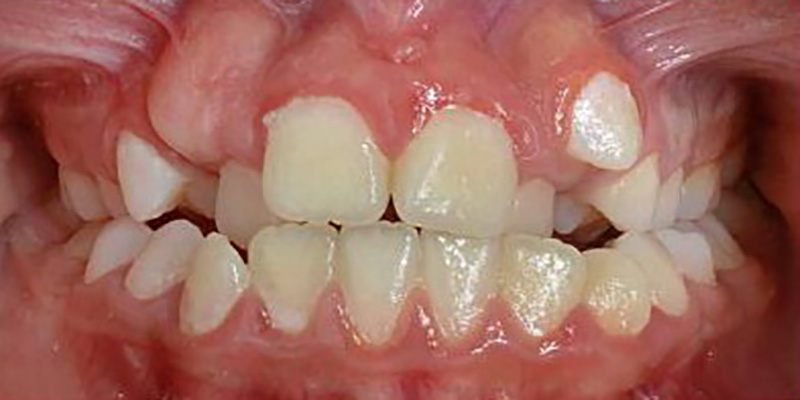 قبل از درمان نامرتبی دندانی ناشی از تنگی و قوس فکی توسط دکتر فریناز شیربان متخصص ارتودنسی در اصفهان
