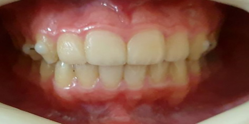 قبل از درمان نامرتبی دندانی ناشی از تنگی و قوس فکی توسط دکتر فریناز شیربان متخصص ارتودنسی در اصفهان