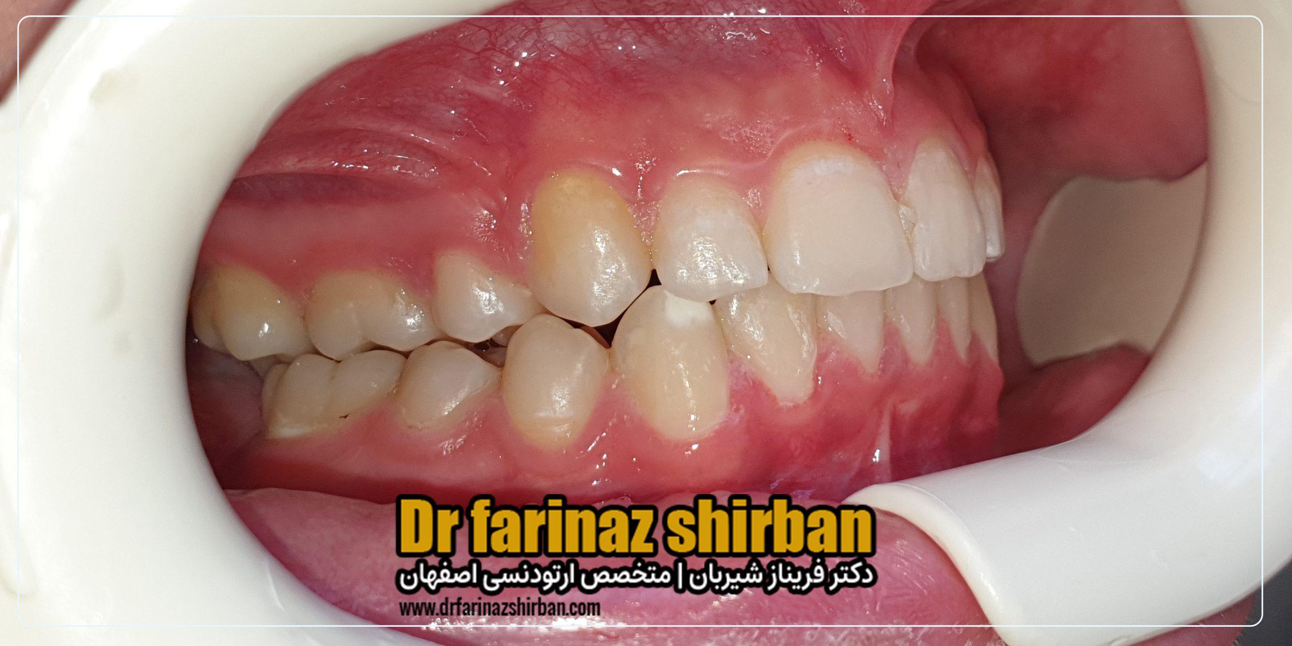 نمونه درمان اصلاح تنگی قوس فک و نامنظمی دندان ها بدون جراحی و کشیدن دندان توسط دکتر فریناز شیربان متخصص ارتودنسی در اصفهان