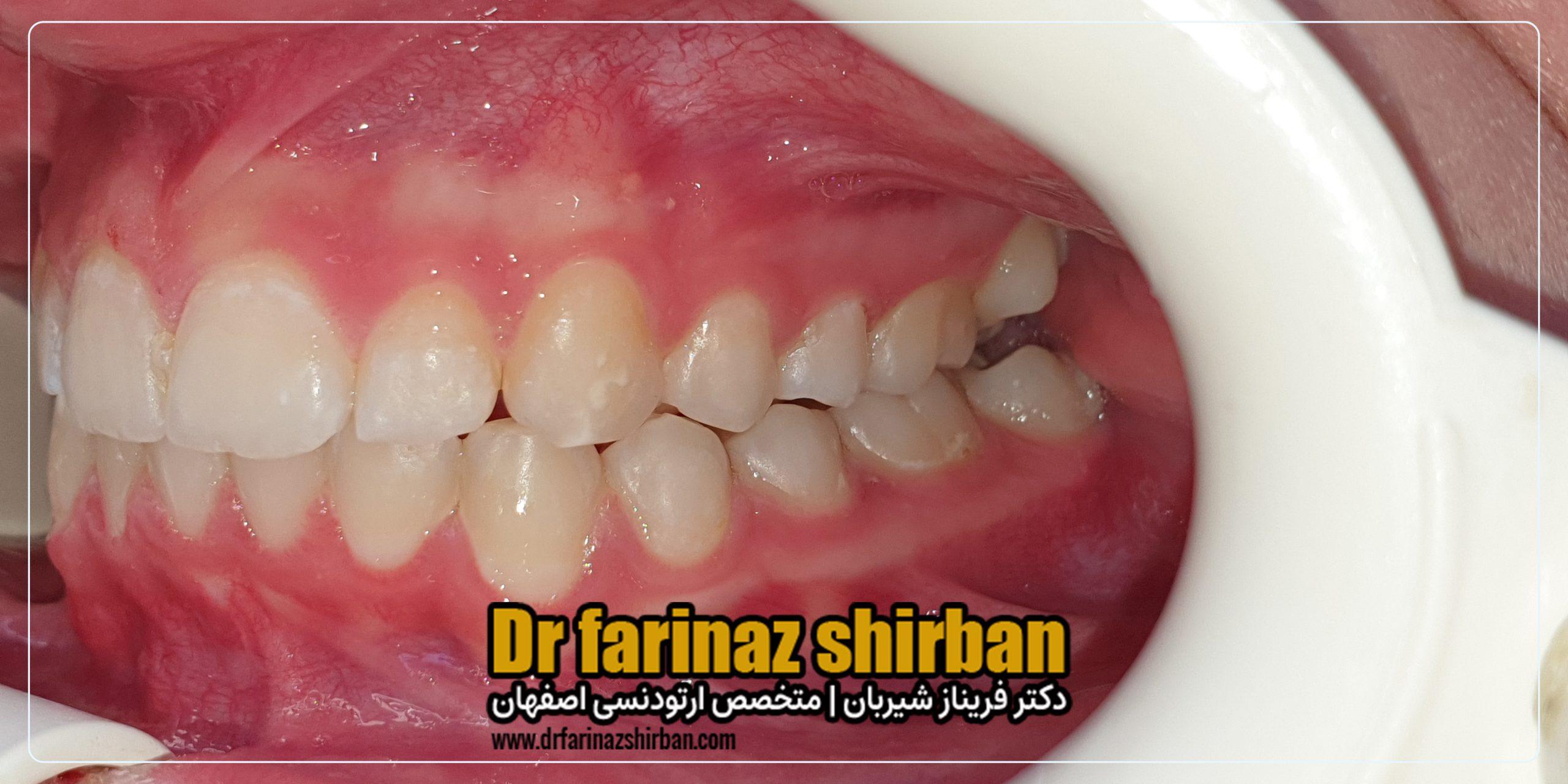 اصلاح تنگی قوس فک و نامنظمی دندان ها بدون جراحی و کشیدن دندان با متخصص ارتودنسی در اصفهان
