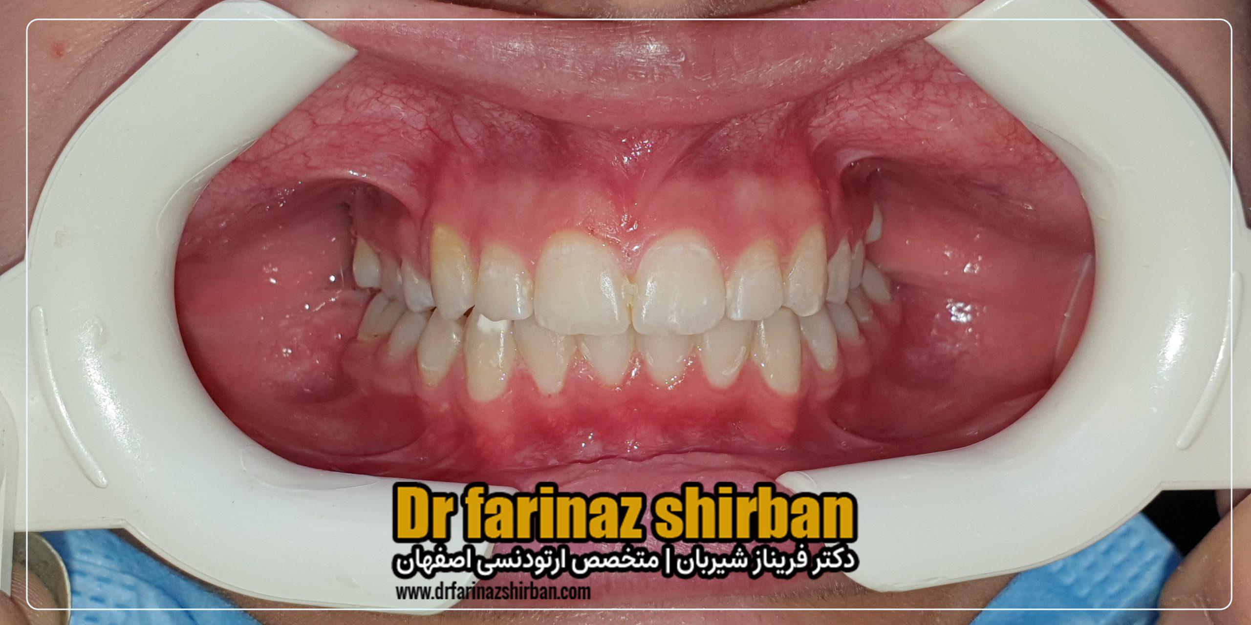 اصلاح تنگی قوس فک و نامنظمی دندان ها بدون جراحی و کشیدن دندان با متخصص ارتودنسی در اصفهان