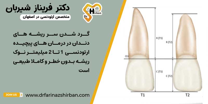 آیا گرد شدن سرریشه دندان در ارتودنسی عوارض دارد