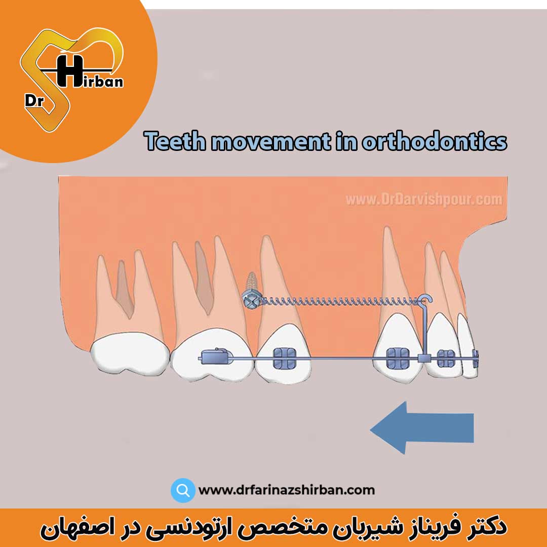حرکت دندان ها پس از درمان ارتودنسی
