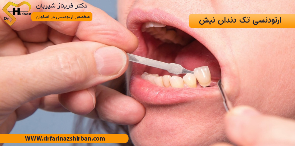 ارتودنسی تک دندان نیش در اصفهان