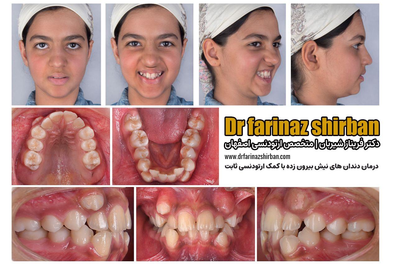 درمان دندان‌های نیش بیرون زده با کمک ارتودنسی ثابت