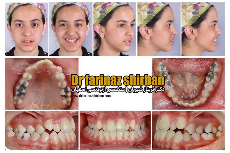 کیس ریپورت اصلاح تنگی قوس ماگزیلا بدون نیاز به جراحی توسط دکتر فریناز شیربان