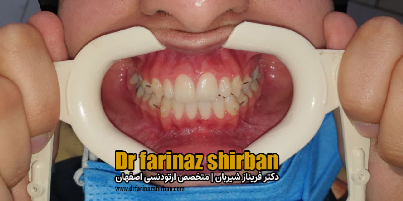 اصلاح تنگی قوس ماگزیلا بدون نیاز به جراحی در سن مناسب توسط دکتر فریناز شیربان