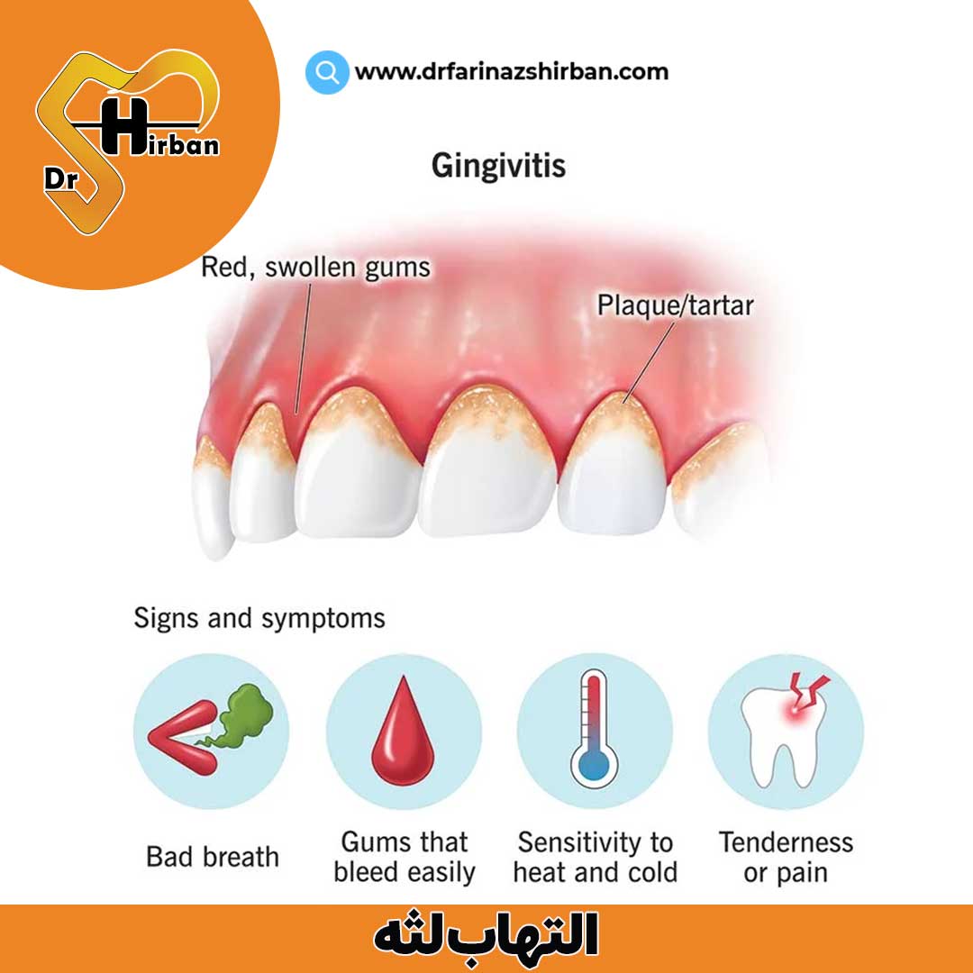 التهاب لثه یا ژنژیویت لثه (Gingivitis)