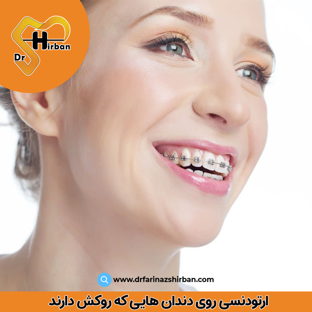 ارتودنسی روی دندان هایی که روکش دارند | مطب ارتودنسی دندان دکتر فریناز شیربان در اصفهان