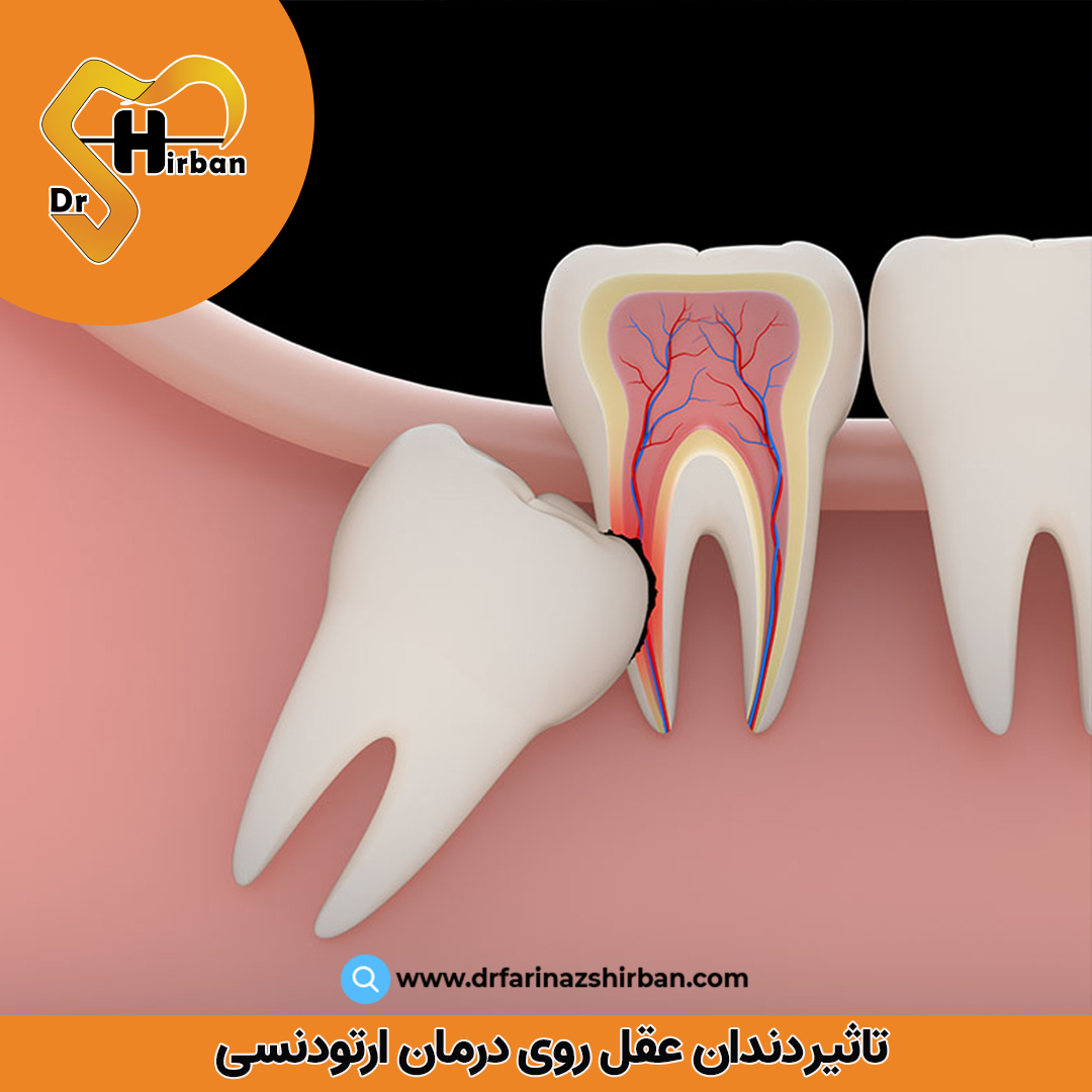 تاثیر دندان عقل روی ارتودنسی دندان | مطب دکتر فریناز شیربان در اصفهان