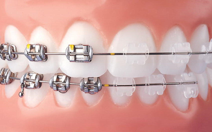 انواع درمان ارتودنسی | ارتودنسی دندان همراه با کامپوزیت