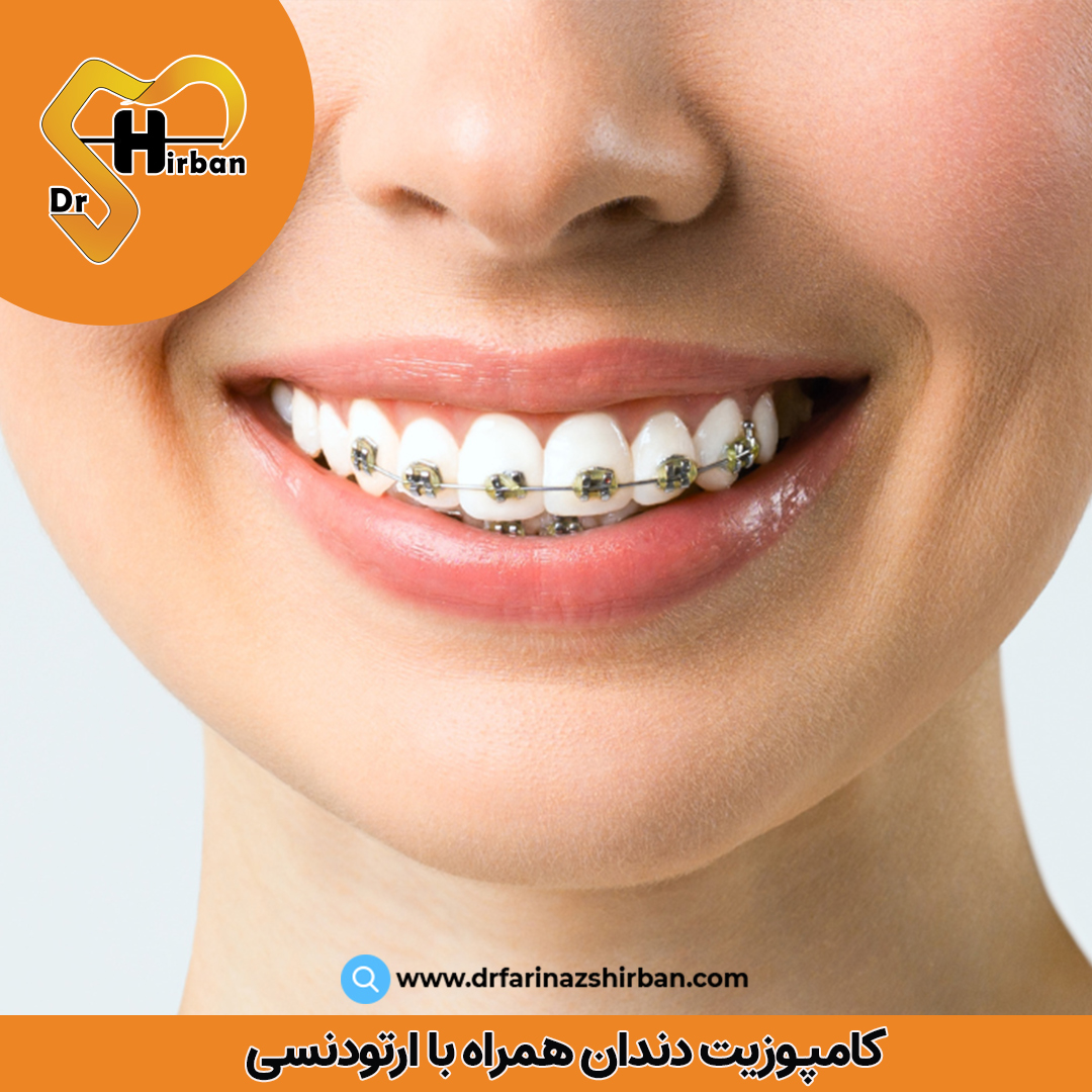 کامپوزیت دندان همراه با ارتورنسی | دکتر فریناز شیربان در اصفهان