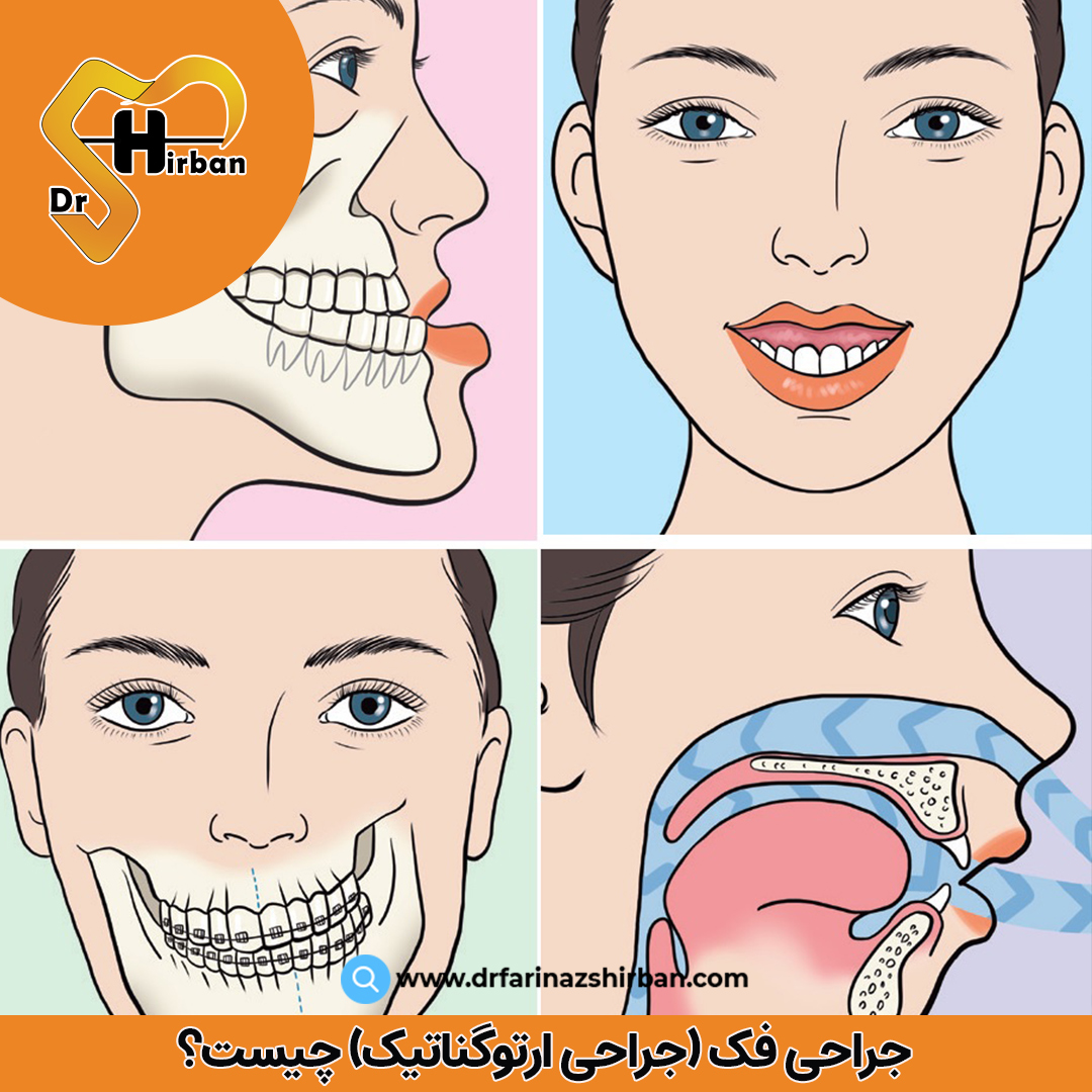 جراحی فک چیست؟ | مطب ارتودنسی دکتر فریناز شیربان در اصفهان