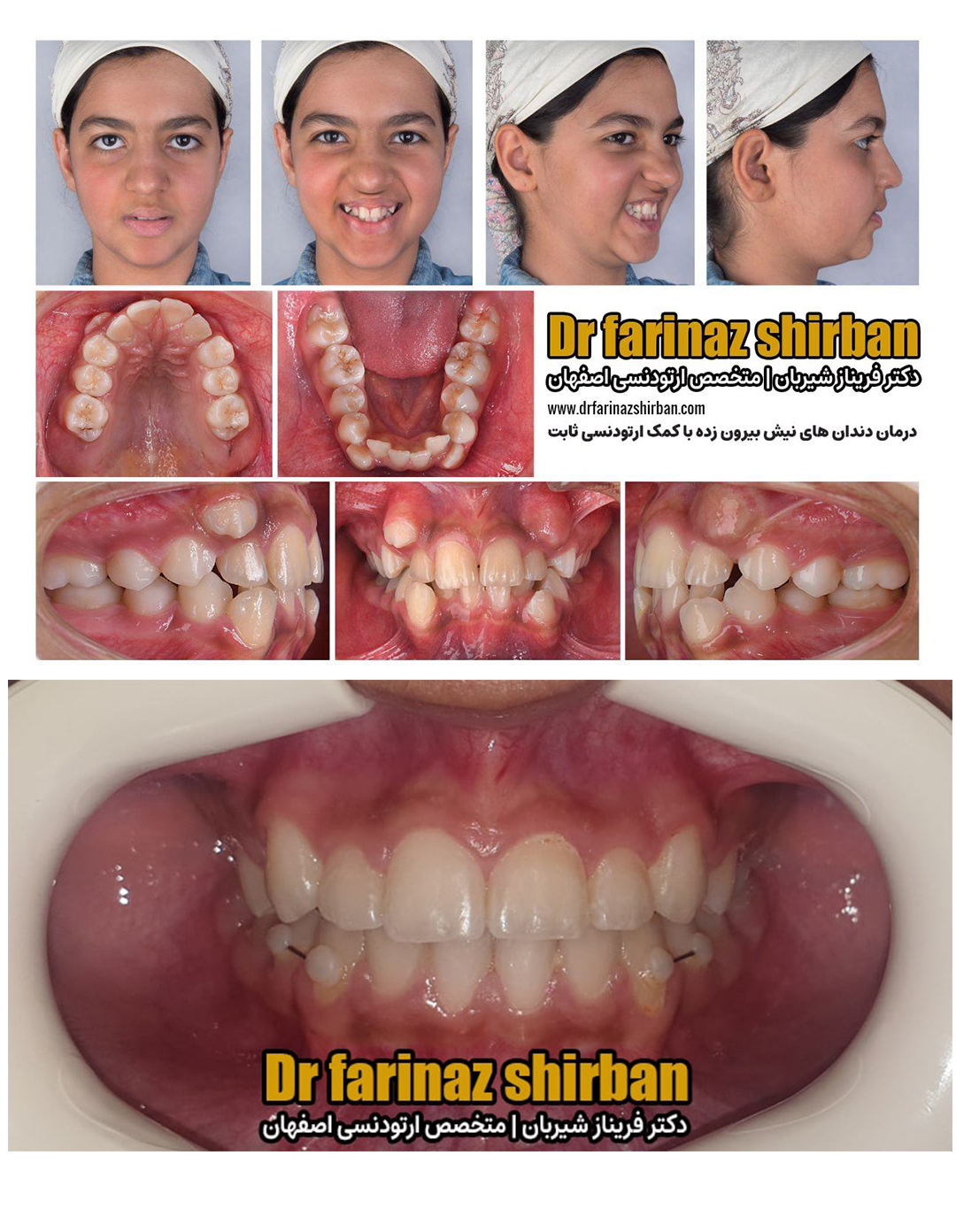 نمونه درمان ارتودنسی در اصفهان توسط دکتر فریناز شیربان