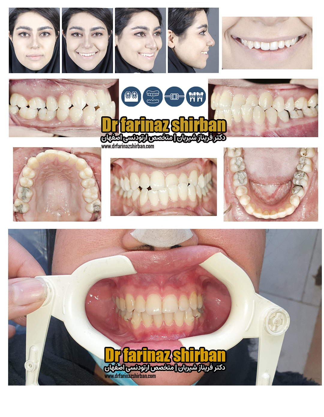 نمونه درمان ارتودنسی در اصفهان توسط دکتر فریناز شیربان