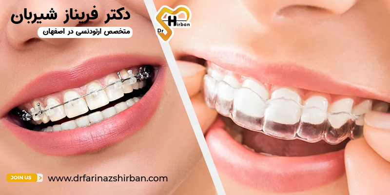 اینویزیلاین بهتر است یا بریس های فلزی | مرکز ارتودنسی دندان اصفهان