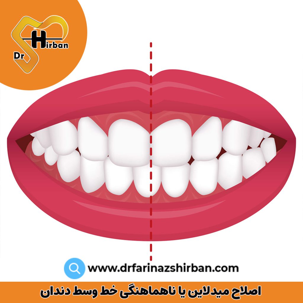 اصلاح میدلاین یا ناهماهنگی خط وسط دندان | دکتر فریناز شیربان