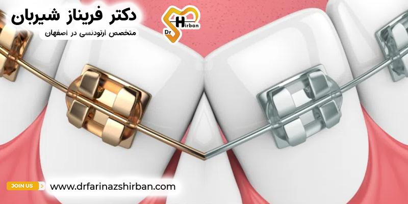 بریس‌های طلا در مقابل بریس‌های فلزی | دکتر فریناز شیربان