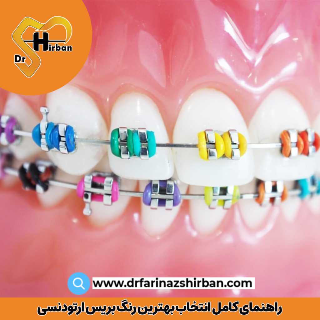 راهنمای کامل انتخاب بهترین رنگ بریس ارتودنسی | دکتر فریناز شیربان
