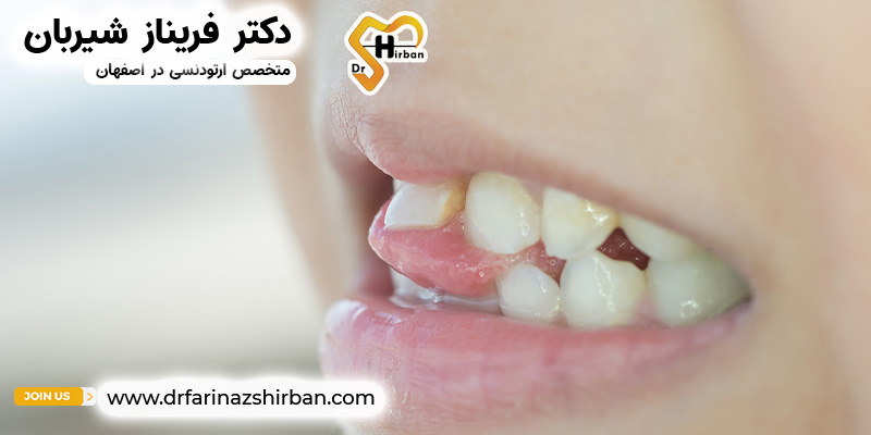آیا می‌توان با دندان لق بریس گرفت؟ | دکتر فریناز شیربان در اصفهان