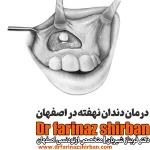 درمان دندان نهفته در اصفهان درمان دندان نیش نهفته در اصفهان ارتودنسی دندان نفهته در اصفهان