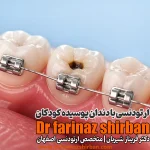پوسیدگی دندان کودکان و ارتودنسی در اصفهان