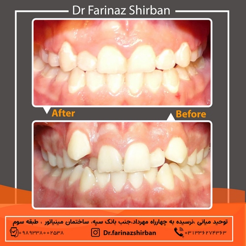 نمونه کار ارتودنسی کودکان توسط دکتر فریناز شیربان